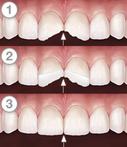 tooth-bonding