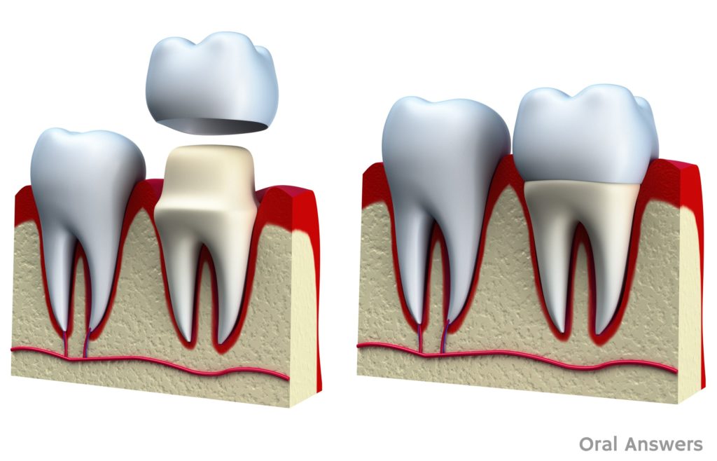 re-cement-tooth-what-to-do-when-you-need-help-best-root-canal