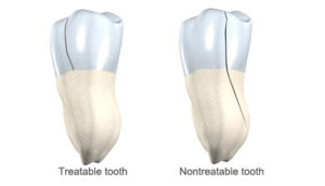 cracked tooth