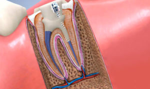 root-canal-therapy